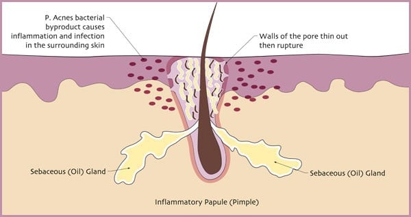 Attack Acne at the Cellular Level – No Drugs, No Hype, Just Results